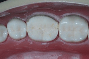 Image of Creating Chamfer Margins