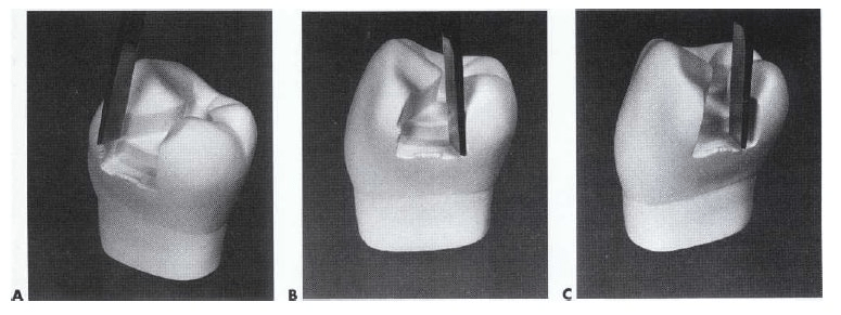 Image of refinement for Cavity Preparation