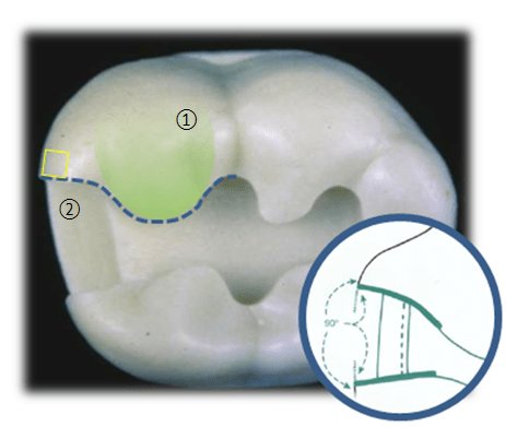 Image of a Reverse-S Curve on a tooth